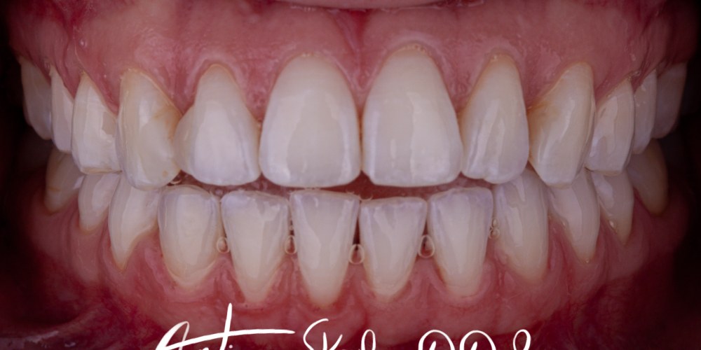 Invisalign Patient before treatment