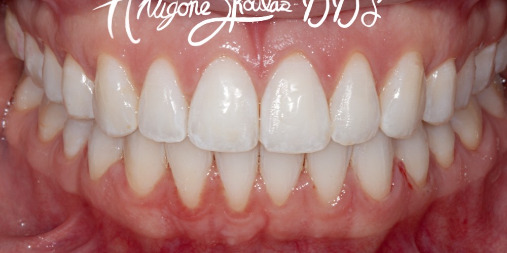 Invisalign Patient after treatment